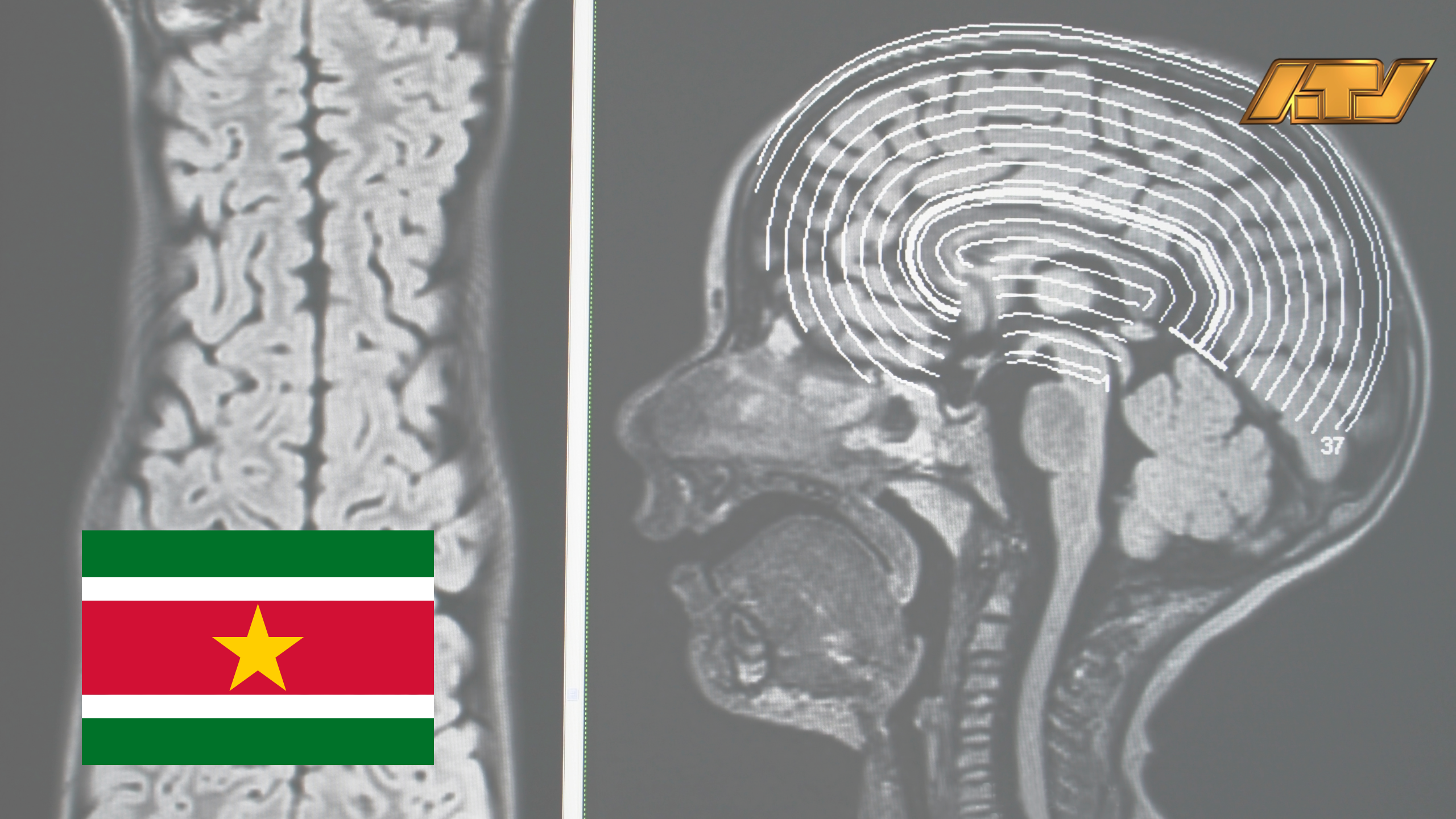 Epilepsie verdient meer aandacht in Suriname: Pleidooi voor bewustwording en betere zorg